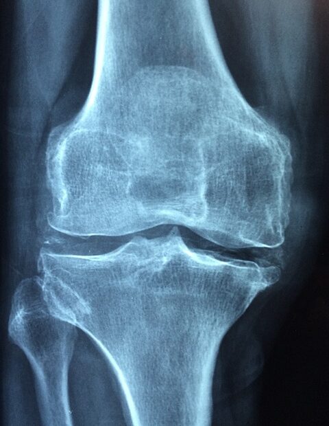 Parkinson's Pain -phot of a knee x-ray to show joint pain